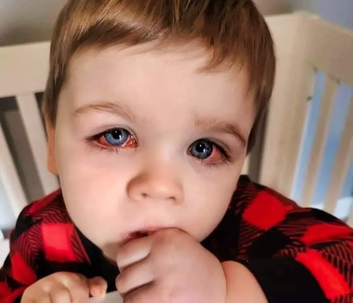 Mom Issues Warning After Toddler Nearly Lost Eyesight From Bath Toy