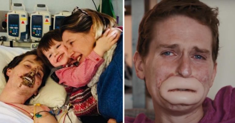 Dad left unrecognizable after losing his lips and four limbs to flesh-eating bacteria – This is what he looks like today