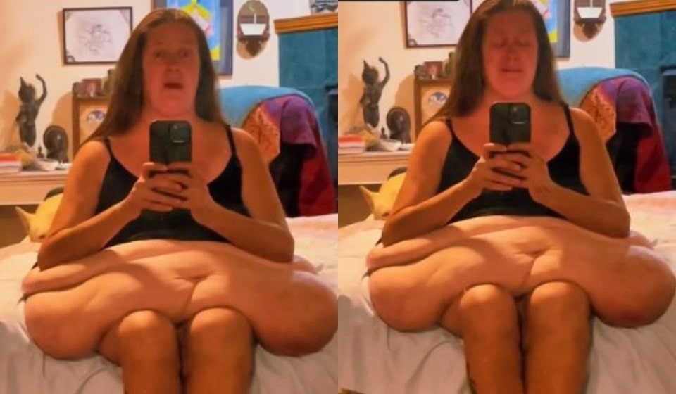 A woman posted a video of the excess skin left after losing enormous weight.