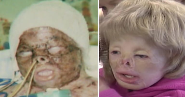 Toddler gets 90 percent burns and survives house blaze against all odds – this is her today