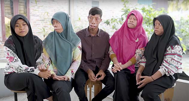 The Manurung family has a mysterious facial condition – now they inspire millions worldwide