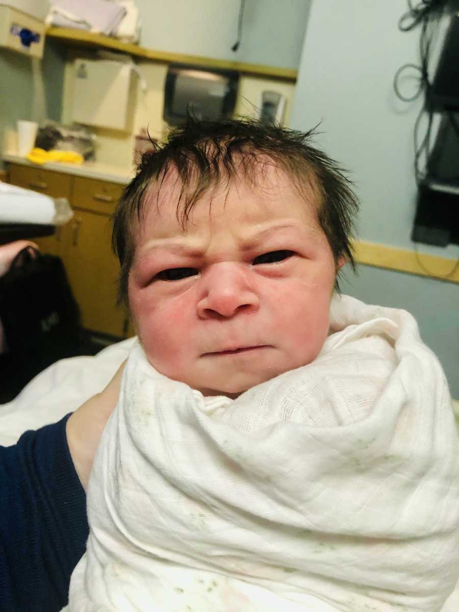 Baby born with an “angry” face and get Oligohydramnios diagnosis