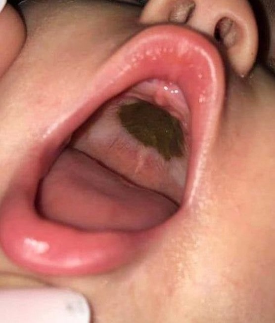 She saw a black spot in her daughter’s mouth and rushed her to the hospital