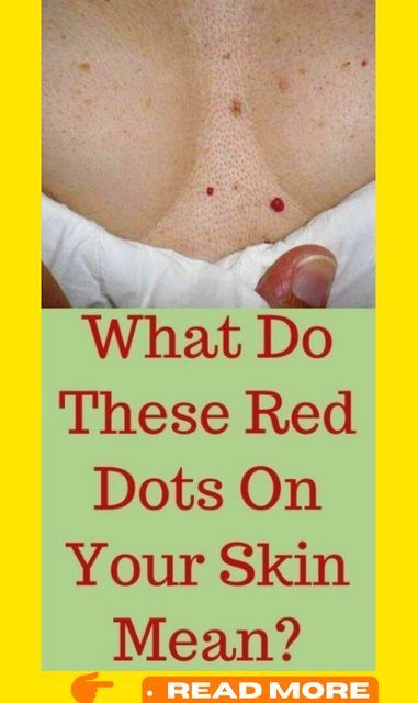 Do You Have These Red Spots On Various Parts Of Your Body Should You Worry – What Should You Do