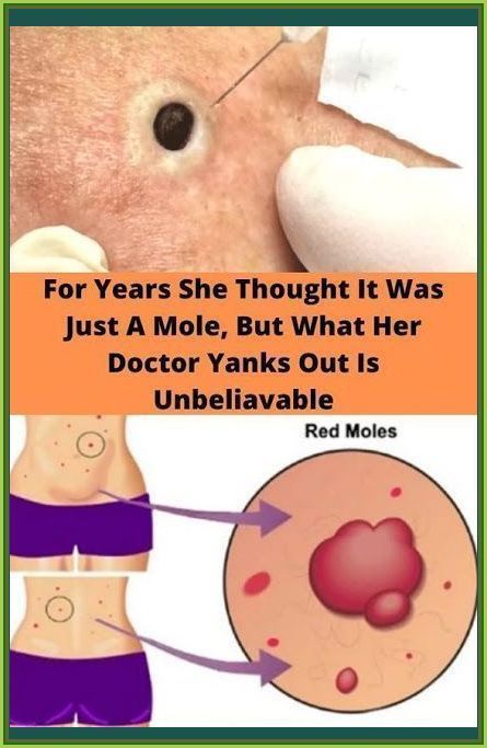 For Years She Thought It Was Just A Mole, But What Her Doctor Yanks Out Is Unbeliavable