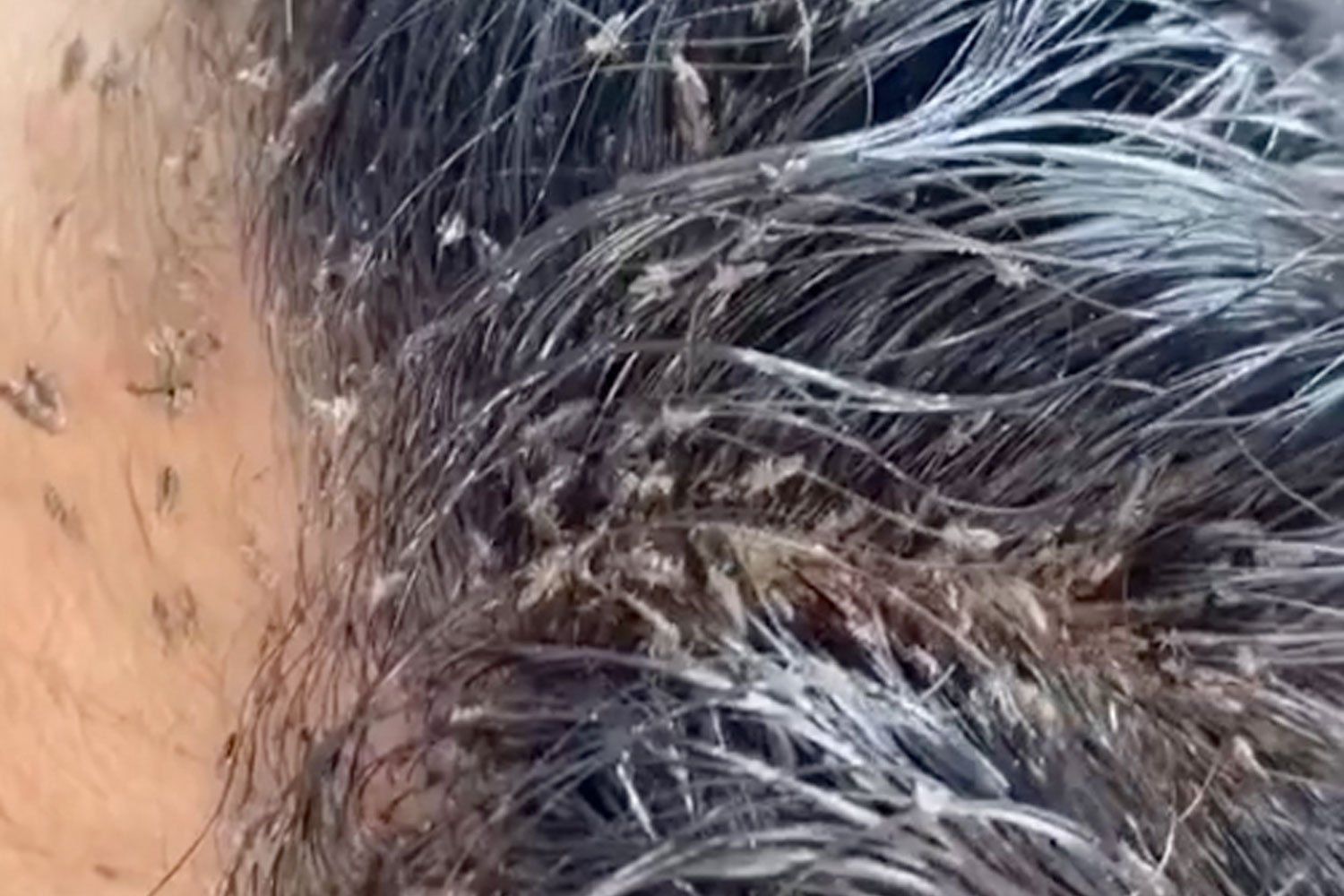 Shocking video shows young girl’s ‘Level 10’ lice infestation