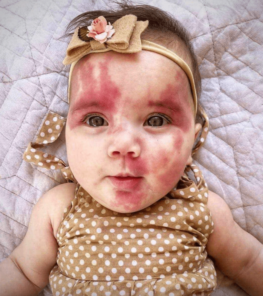 ‘Hideous’ baby has grown into an impressive young girl.