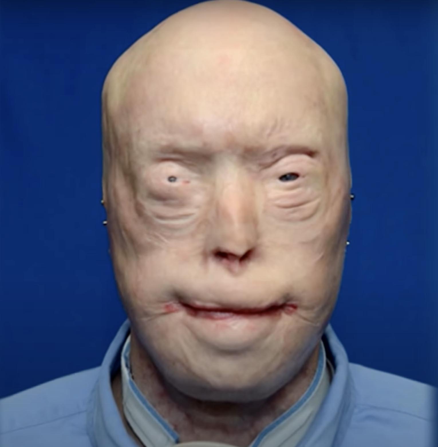 Firefighter has face transplant after third-degree burns & survives against all odds – see him now, 7 years later