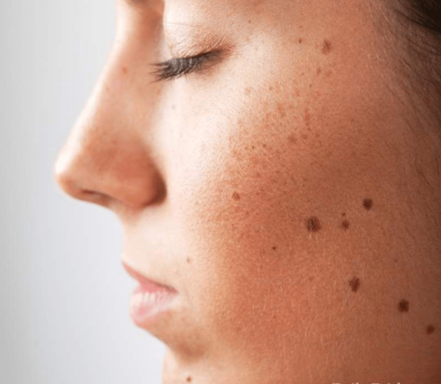 Do You Have These Red Spots On Various Parts Of Your Body Should You Worry – What Should You Do