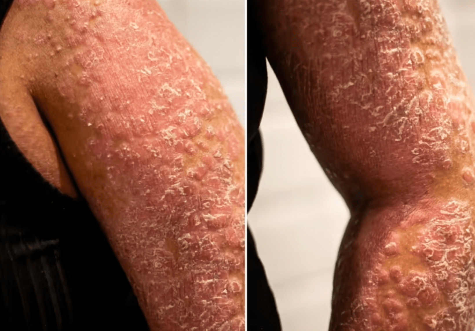 ‘Smells like rotten fish, feels like a curse’: Pain, odour and isolation for people with rare skin disease