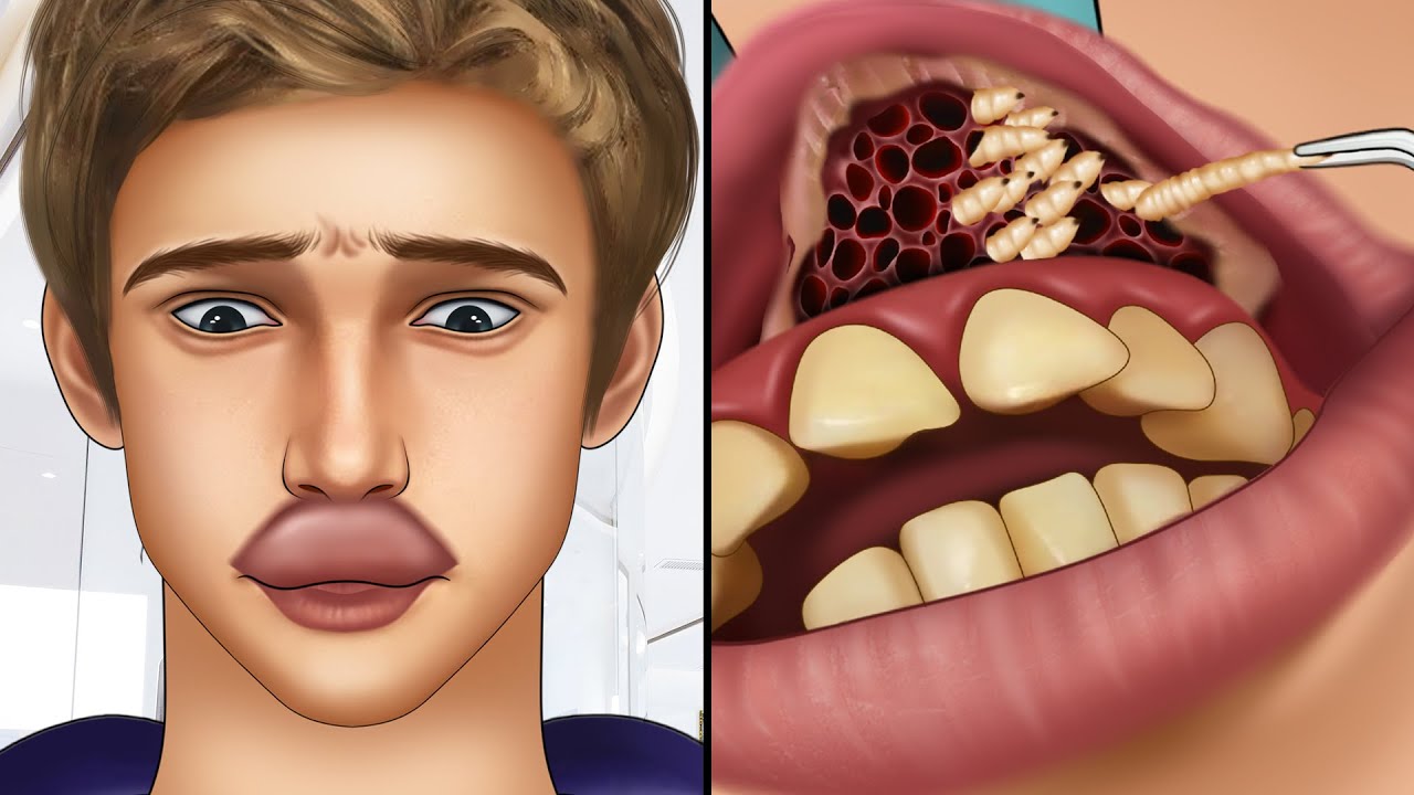 Understanding Mouth Larva Infestation and Effective Prevention Strategies