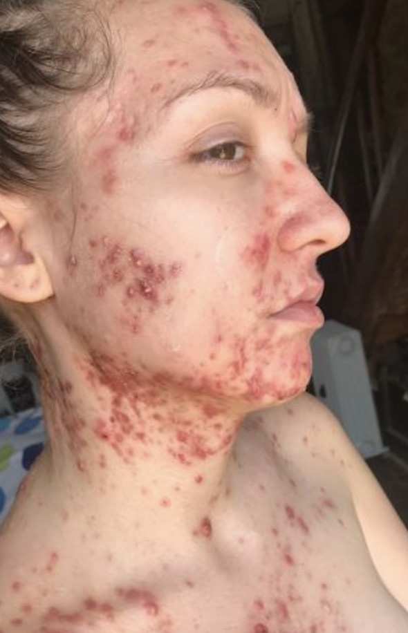 Overcoming Severe Acne: A Journey to Self-Acceptance and Healing