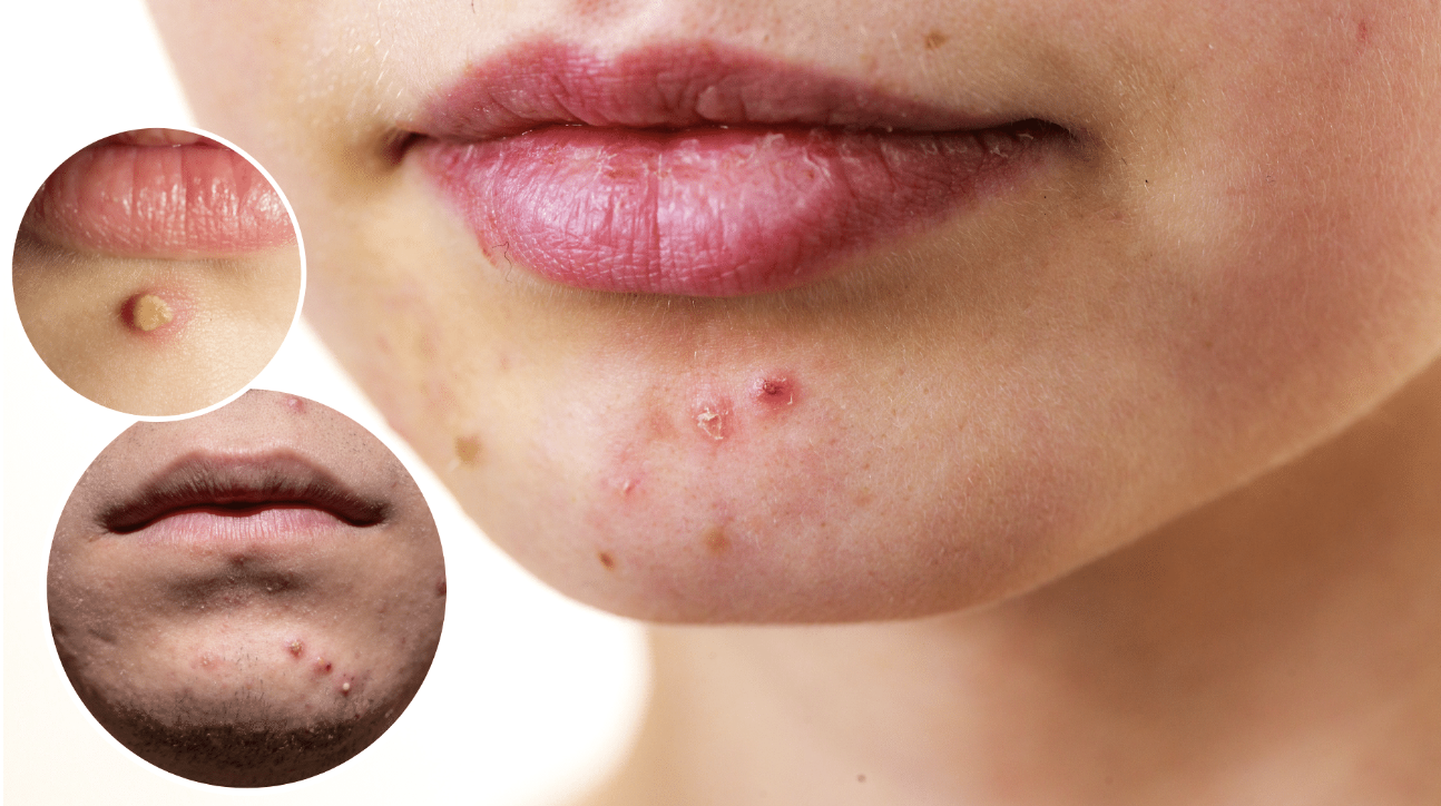 8 Body Parts Acnes Can Appear And What Triggers Them