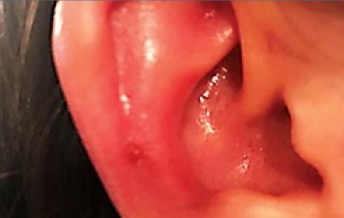 Ear inflammation and redness