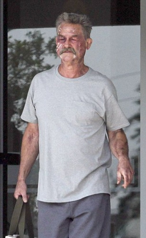 Kurt Russell had what medical conditions? 