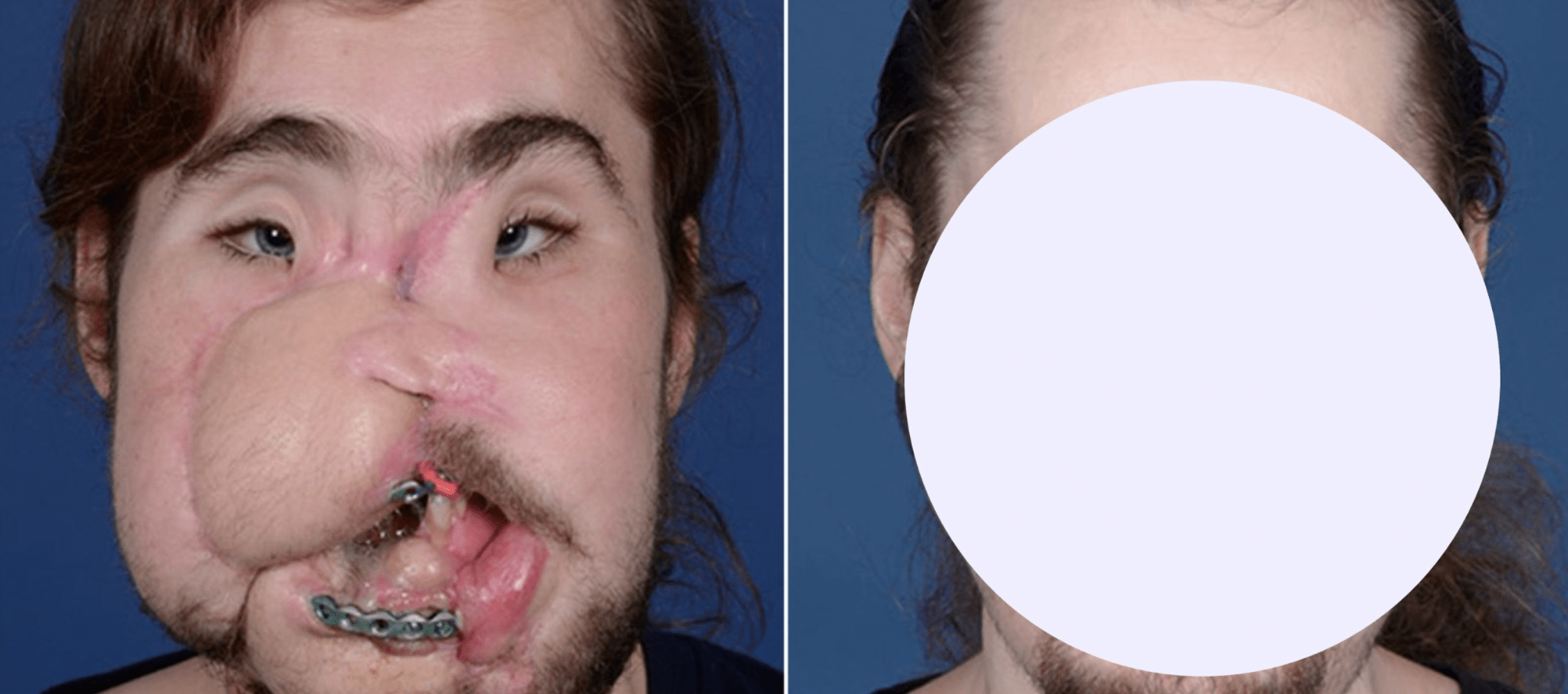 “It’s been well worth it,” the face transplant recipient says after showing the miraculous change that has taken place…