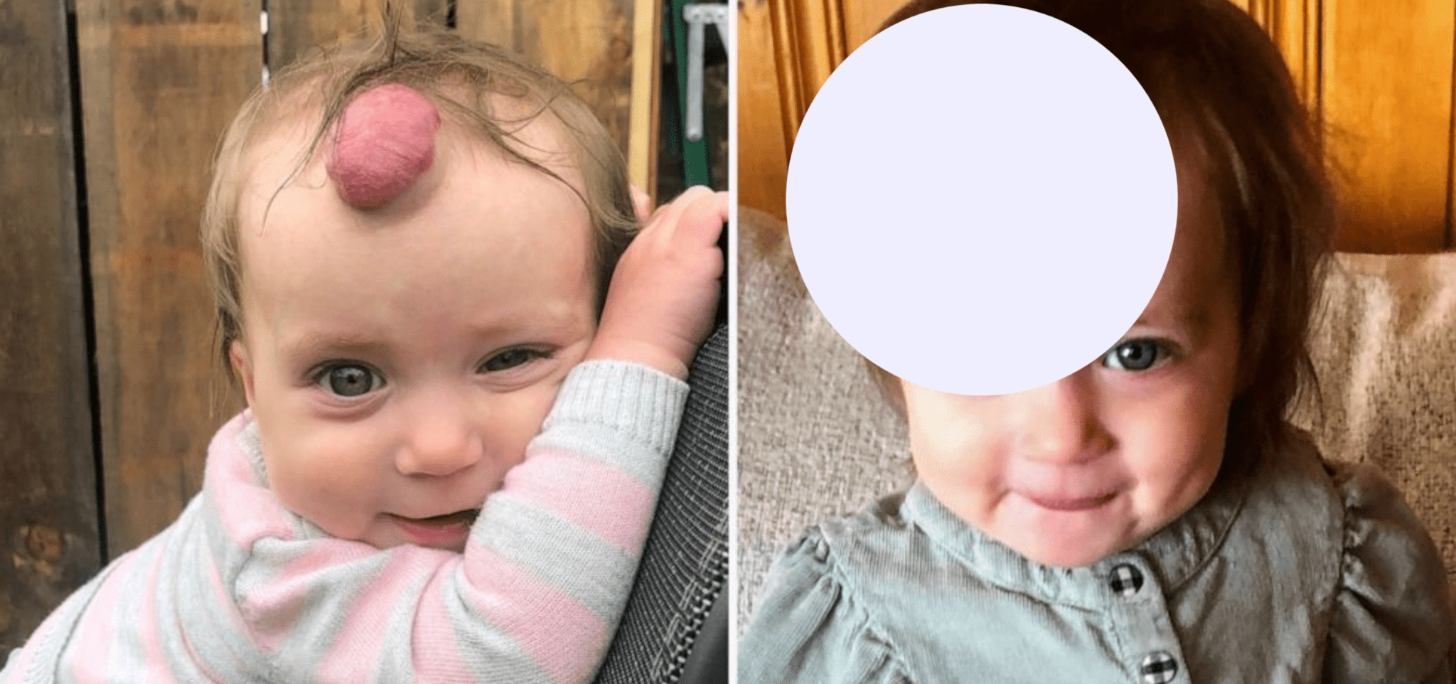 A 1-year-old girl’s blood-filled growth on her forehead is removed… The result is astonishing….