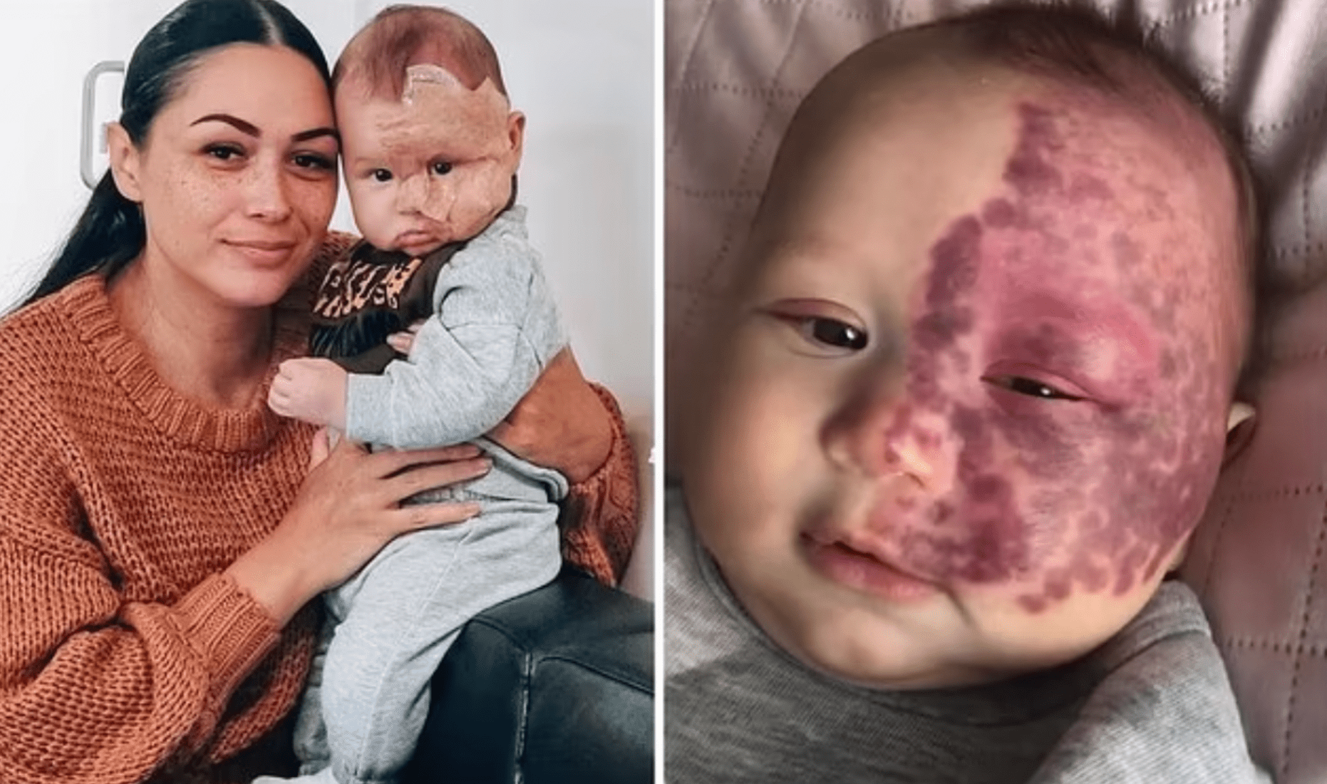 Angry trolls call the mother a “monster” for lasering a port-wine birthmark on her child’s face, but she responds, “It’s far from what they think.”