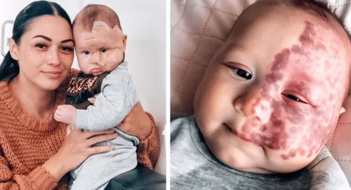 The True Motivation Behind a Mother’s Decision: Removing her Son’s Birthmark with a Laser Sparks Criticism