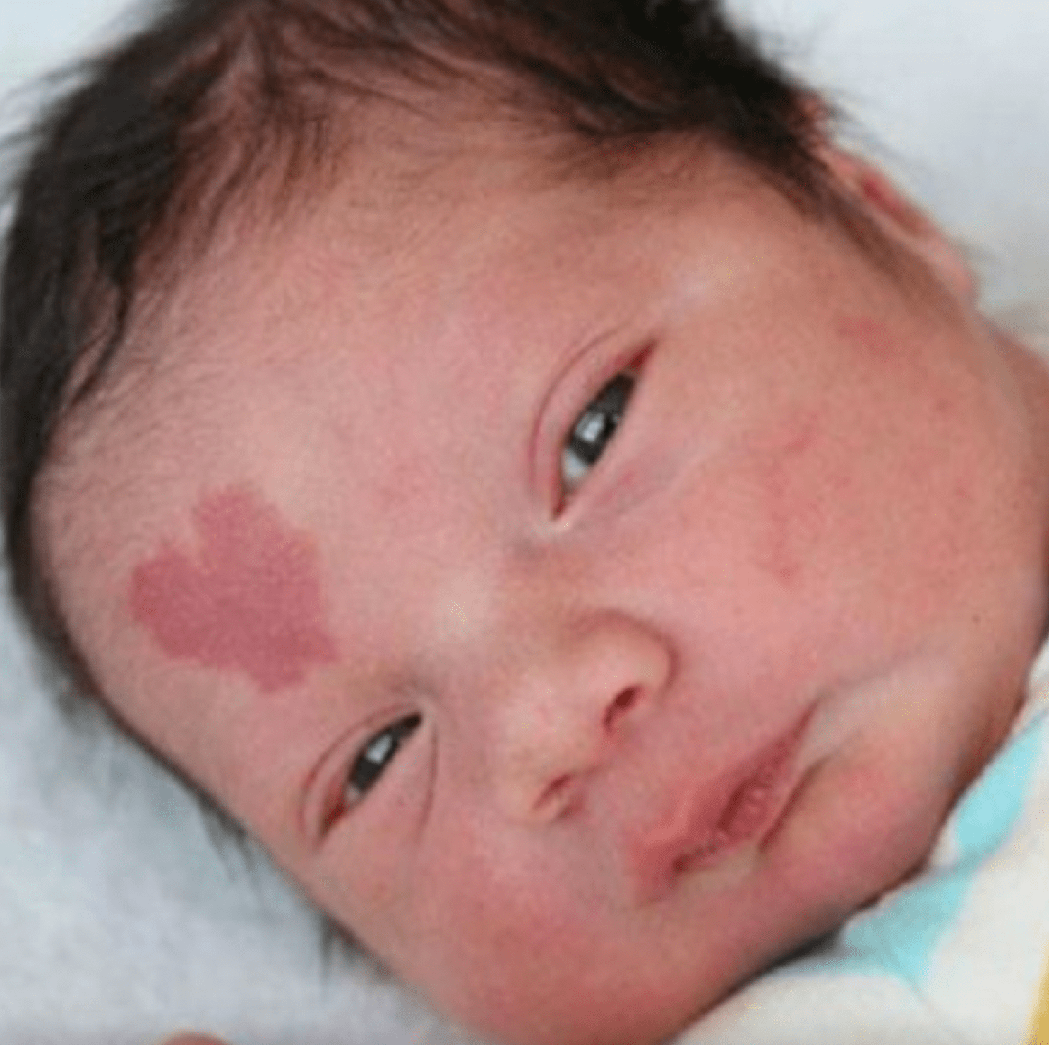 This Baby Boy Was Born With a Rare Birthmark, and Here Is How He Looks 6 Years Later