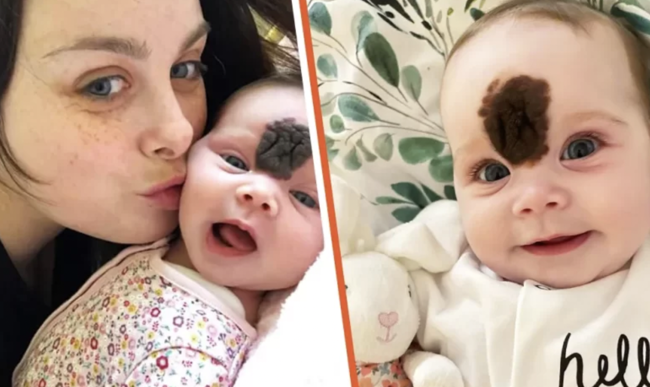 Because Their Daughter Was Born With A Huge Birthmark On Her Face, The Parents Hid The Baby, Until She Had An Operation To Remove It