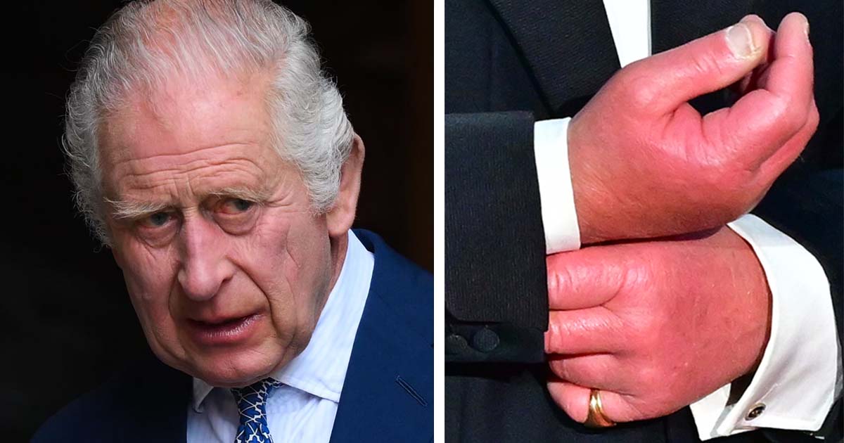 King Charles was bullied for his “sausage fingers” – medical reason behind revealed by expert