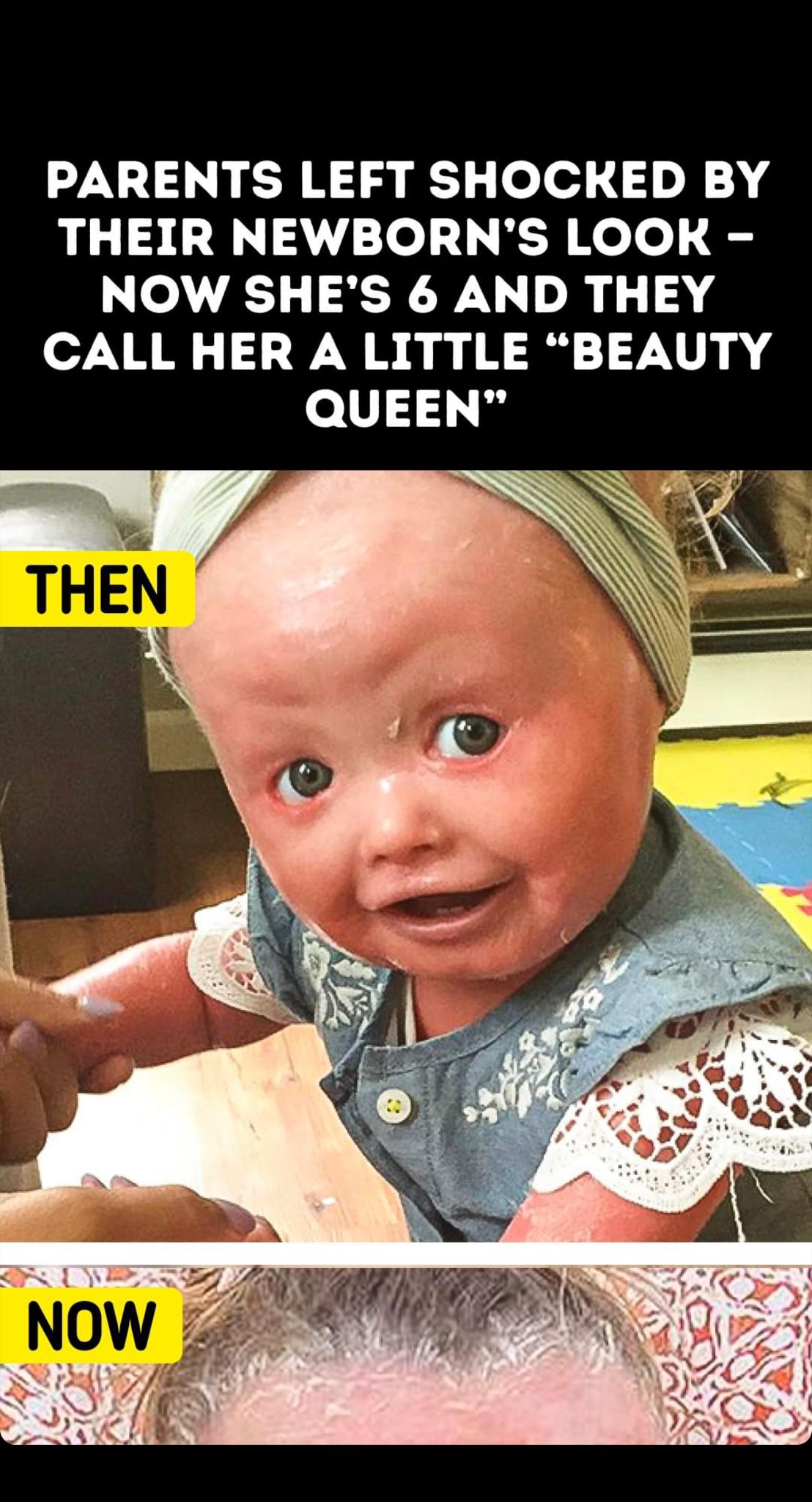 Parents Left Shocked by Their Newborn’s Look — Now She’s 6 and They Call Her a Little “Beauty Queen”