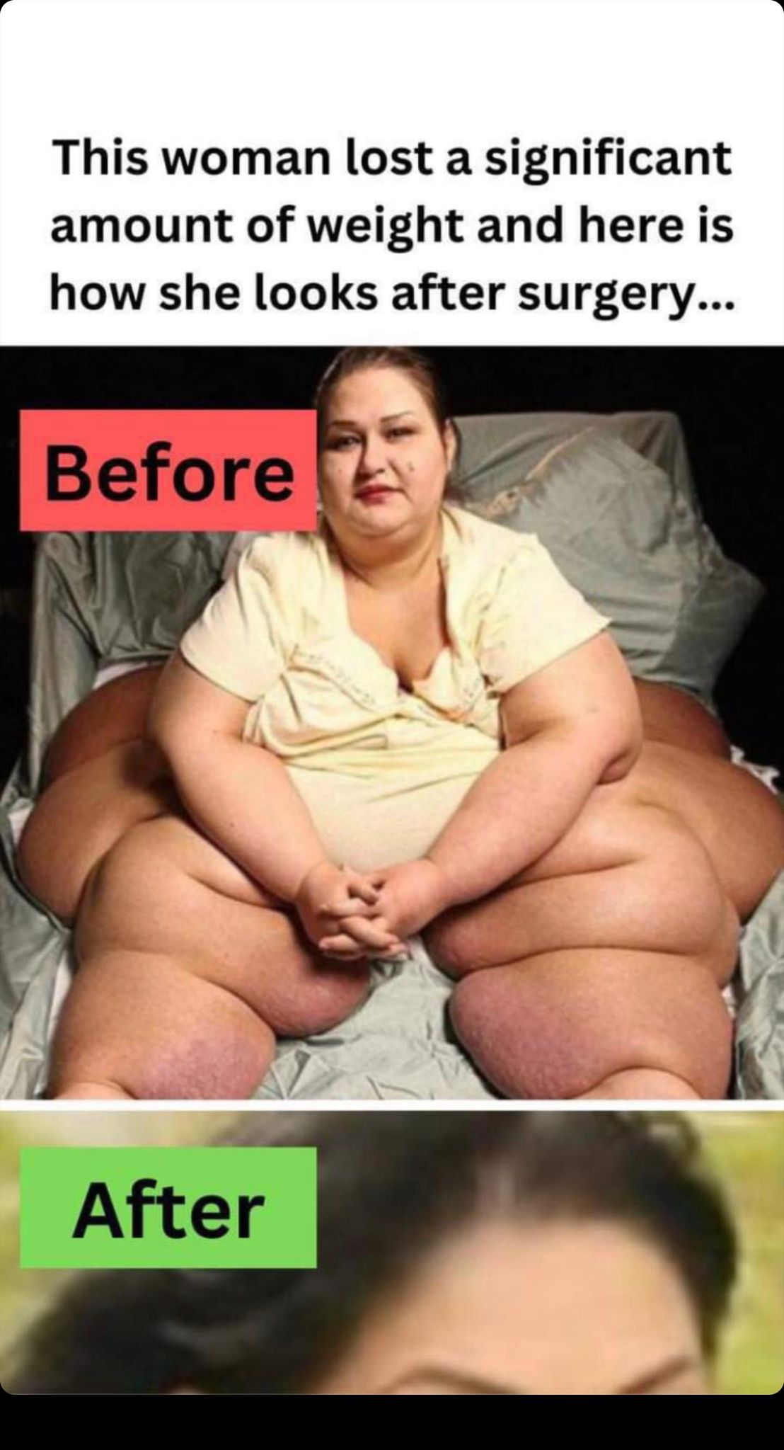 This woman lost a significant amount of weight and here is how she looks after the surgery…