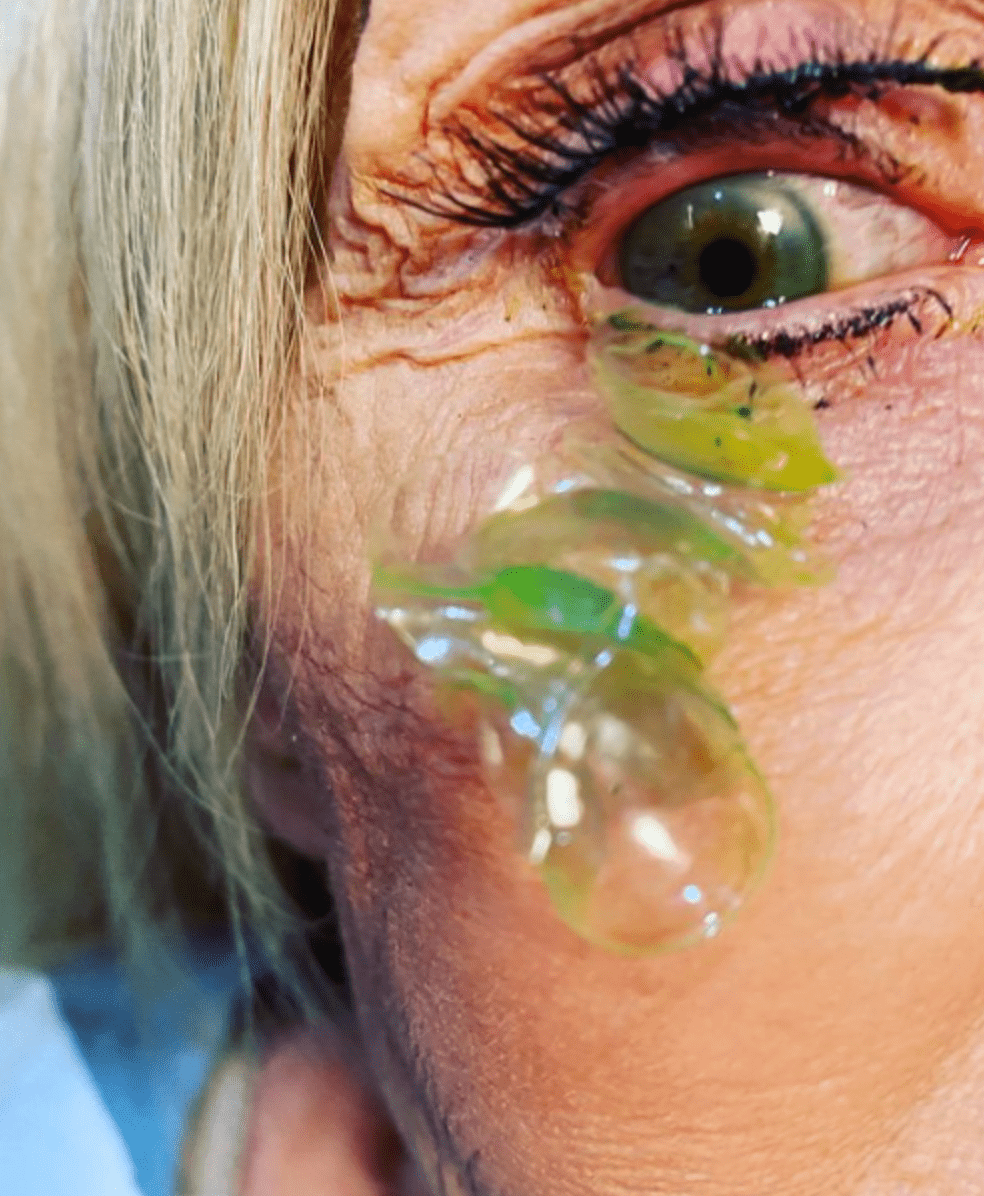 The doctor removed 23 contact lenses stuck in the eye