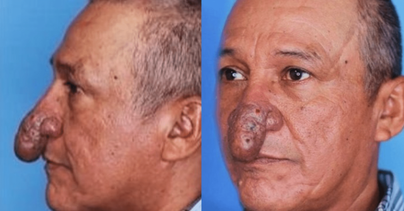 This man represents Pinocchio in real life but here is what he looks like after getting a nosejob…