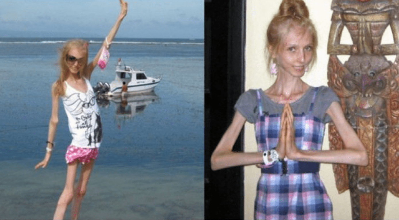 This girl used to weigh 23 kilos but she gained weight and here is how she looks today…