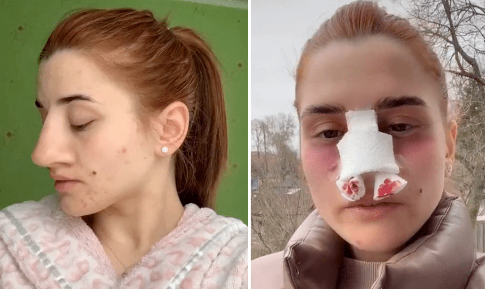 A woman posts before and after photos of her nose operation, and people can’t believe the transformation…