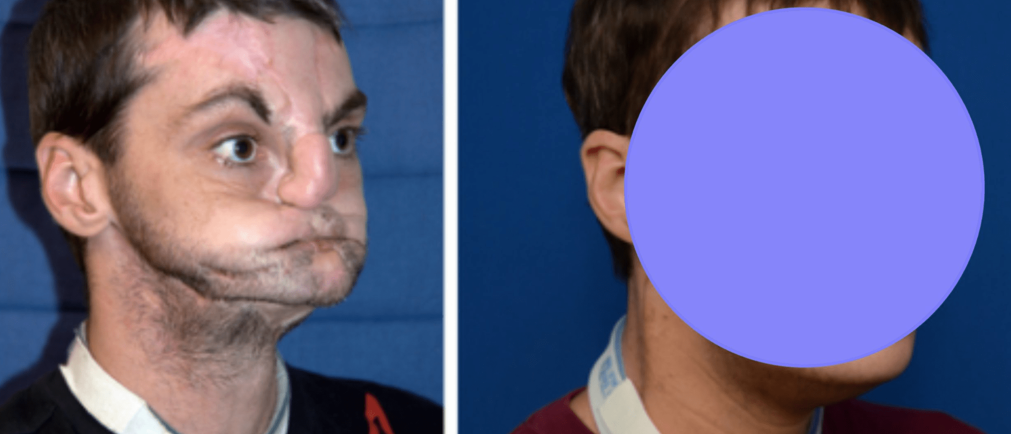 Incredible transformation before and after photos of Richard Lee Norris’ face transplant… It is unbelievable…