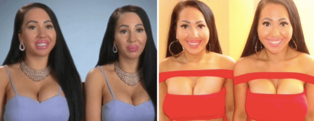 The Most Astonishing Examples Of “botched” Plastic Surgery Transformations 