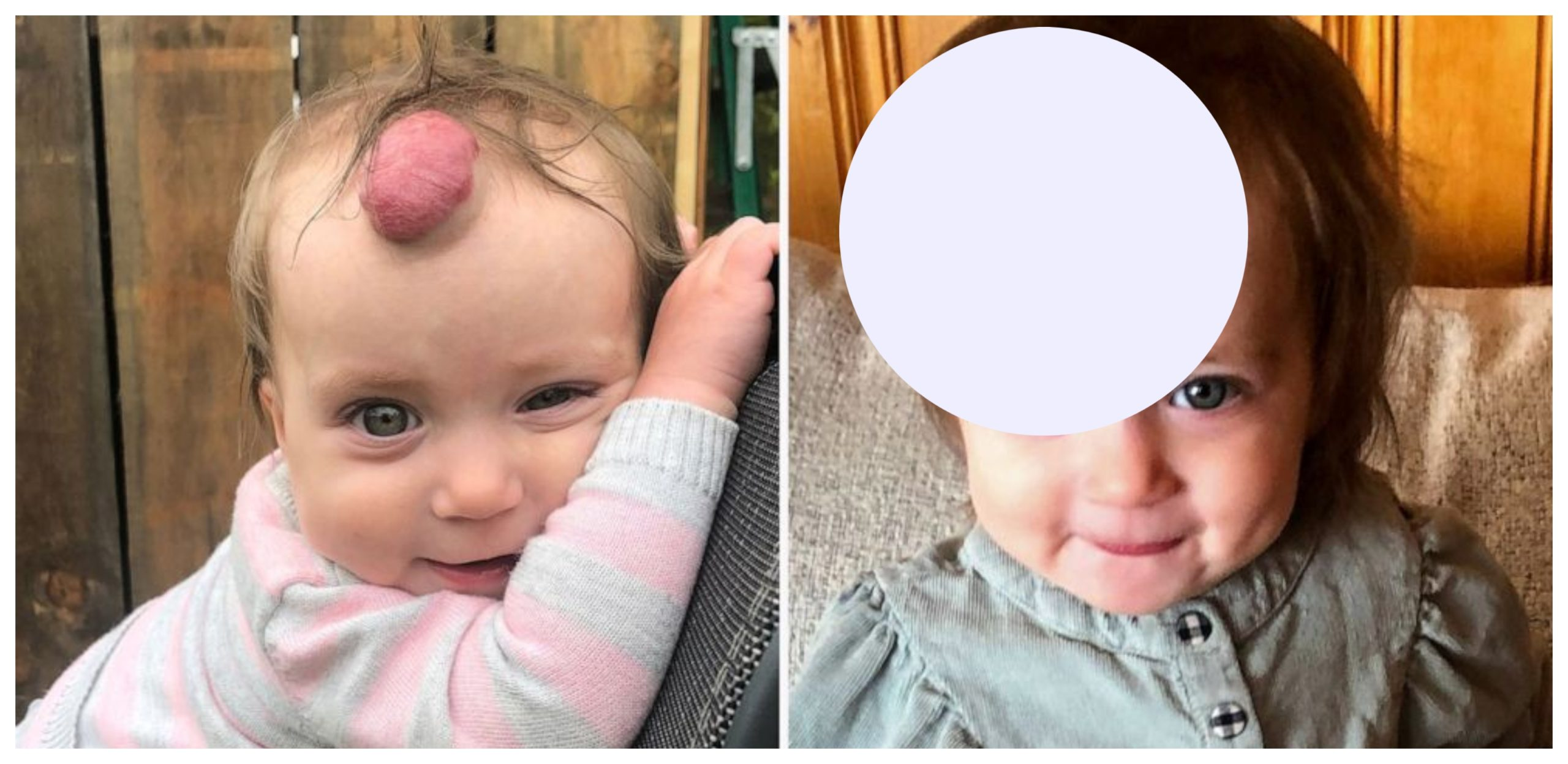 A 1-year-old girl’s blood-filled growth on her forehead is removed… The result is astonishing….