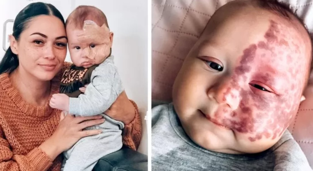 The True Motivation Behind a Mother’s Decision: Removing her Son’s Birthmark with a Laser Sparks Criticism