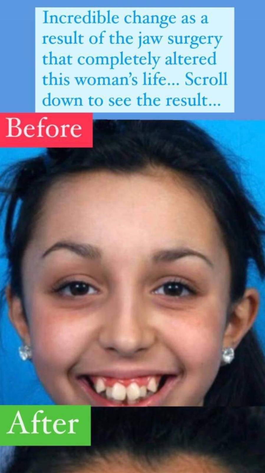 Incredible change as a result of the jaw surgery that completely altered this woman’s life… Scroll down to see the result…