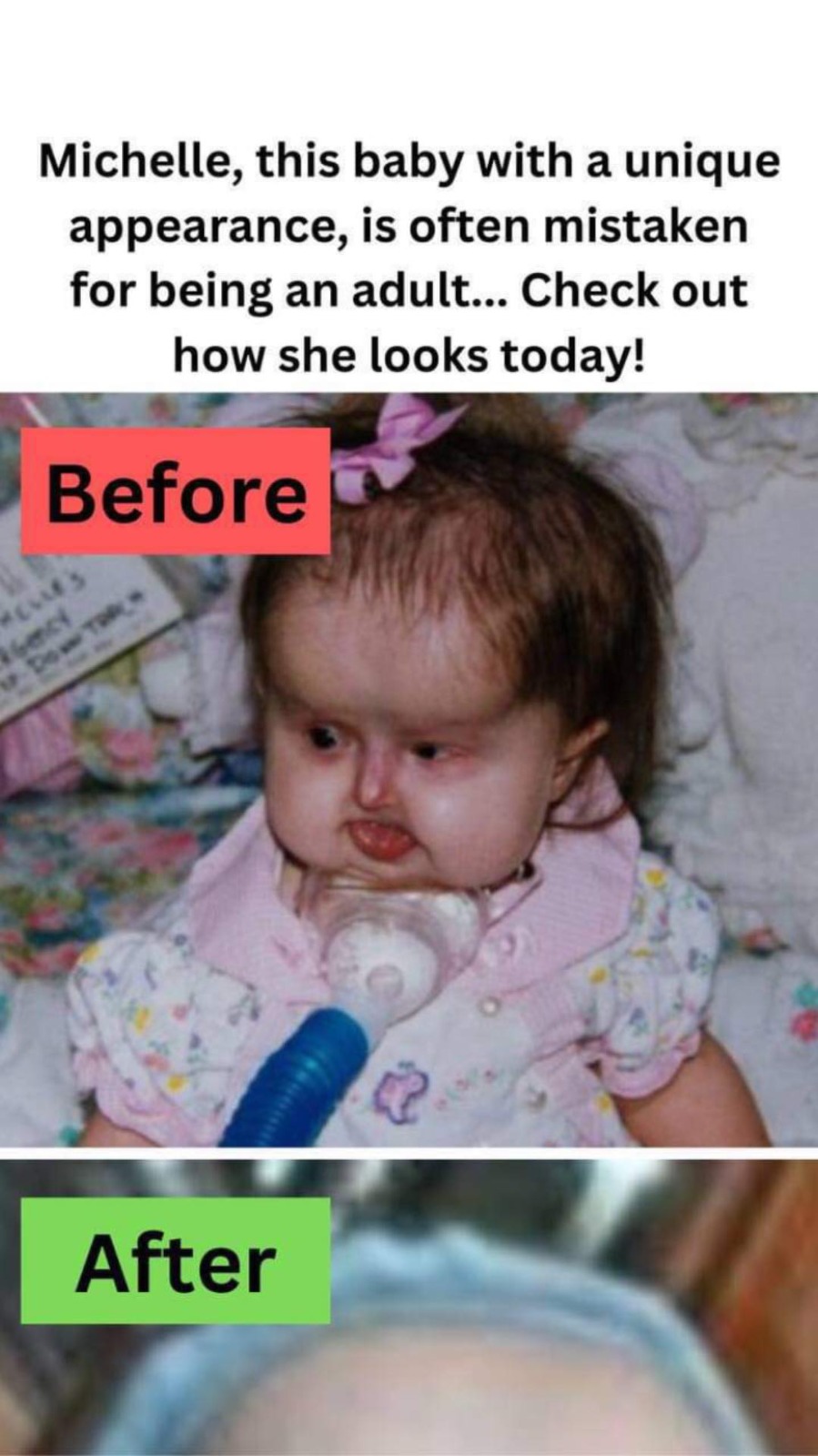 Michelle, this baby with a unique appearance, is often mistaken for being an adult… Check out how she looks today!