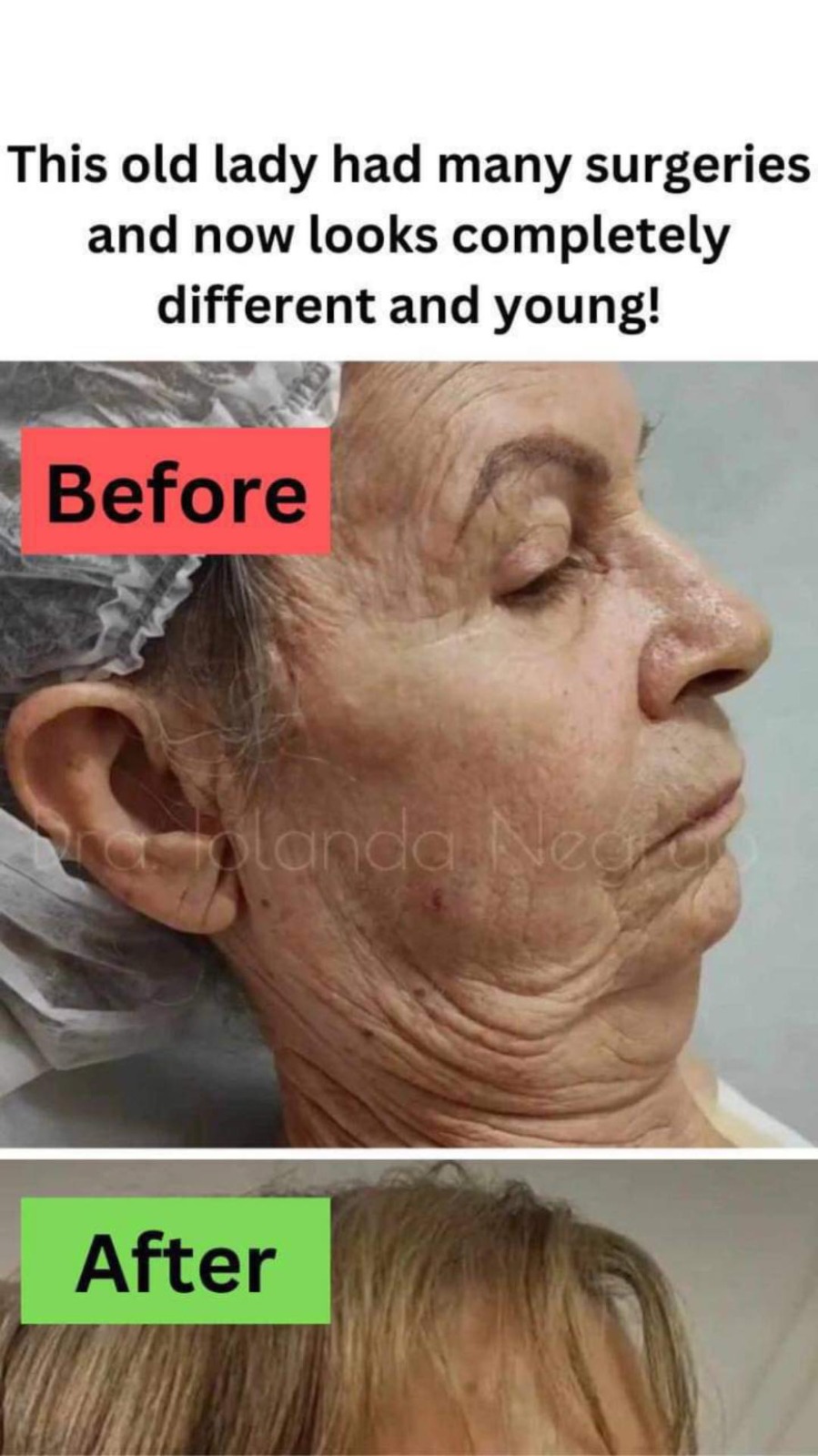 This old lady had surgeries and now after that she looks completely different and young!