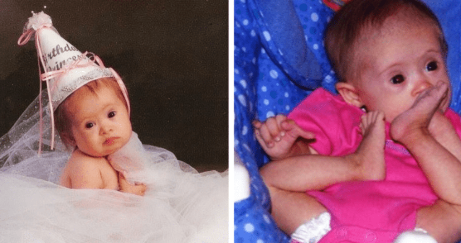 This baby with Down Syndrome was not abandoned by her parents and here is what she looks like after 15 years…