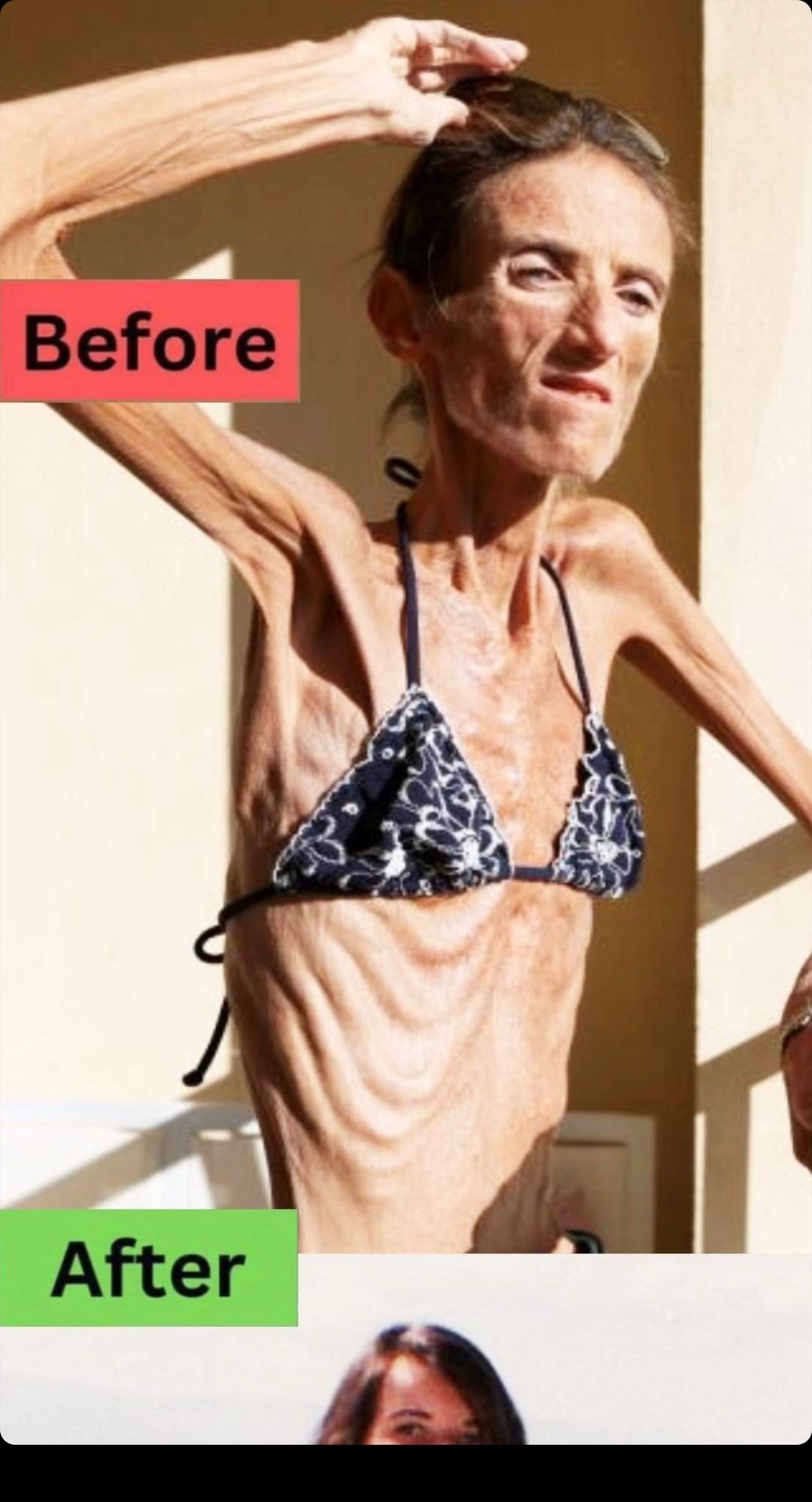 The World’s Thinnest Woman’s Battle Against Anorexia Will Leave You Speechless!