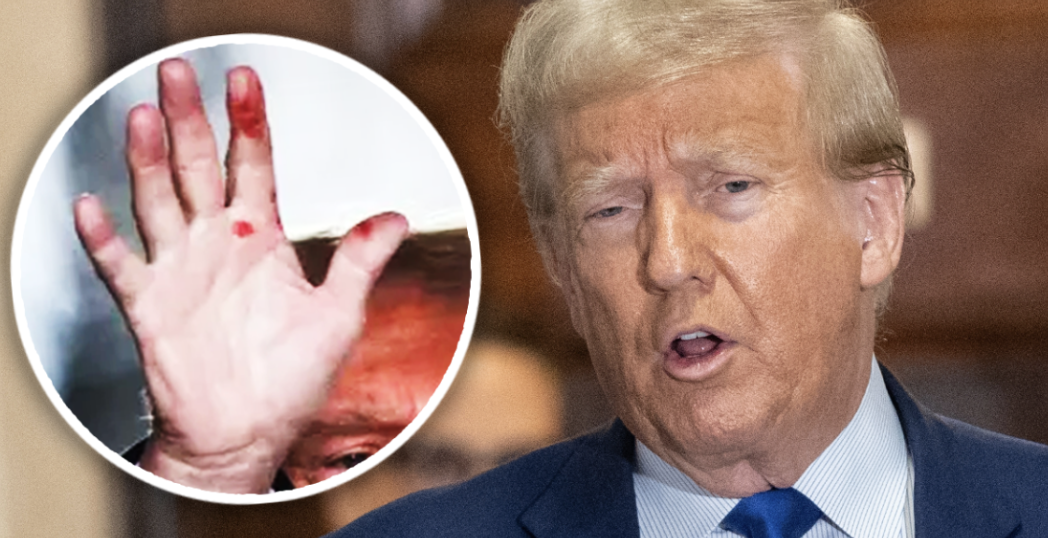 Fans Spot Detail In New Donald Trump Picture That Sparks Worrying Health Rumors