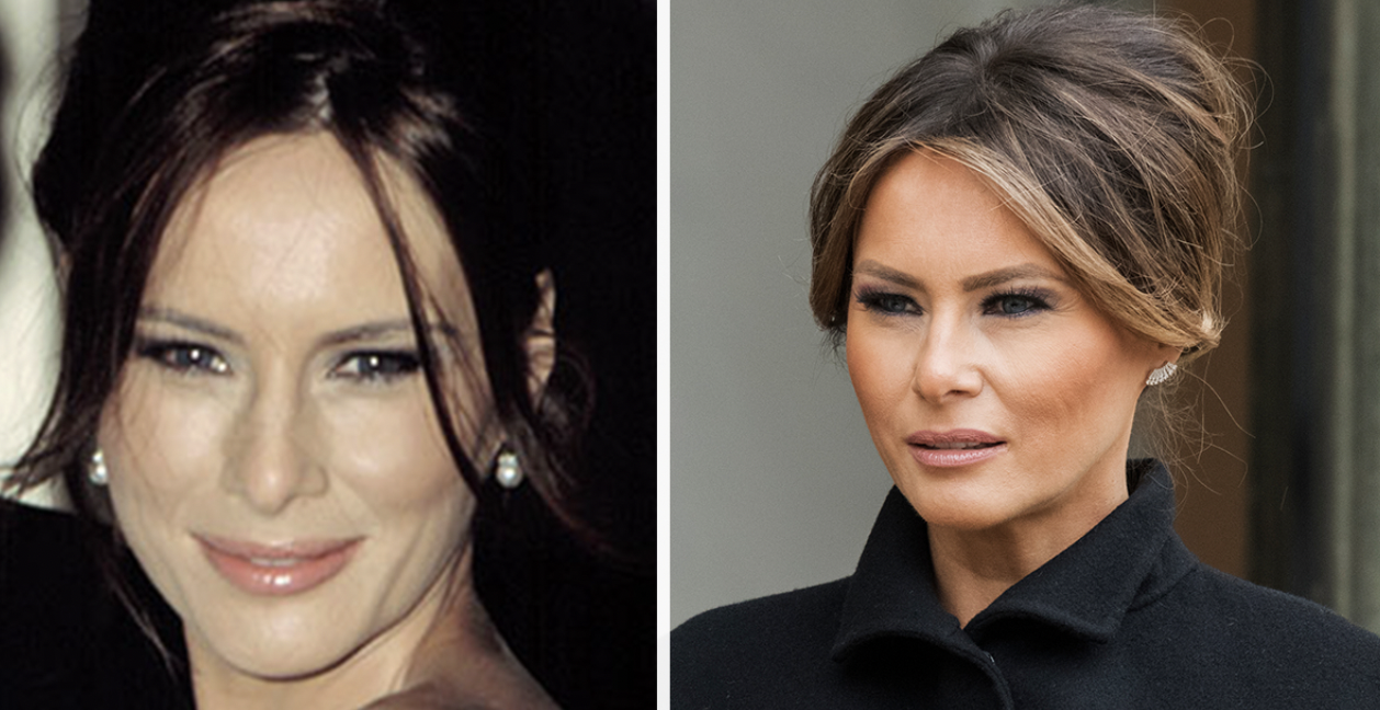 Melania Trump breaks silence on plastic surgery rumors and it confirms what we suspected