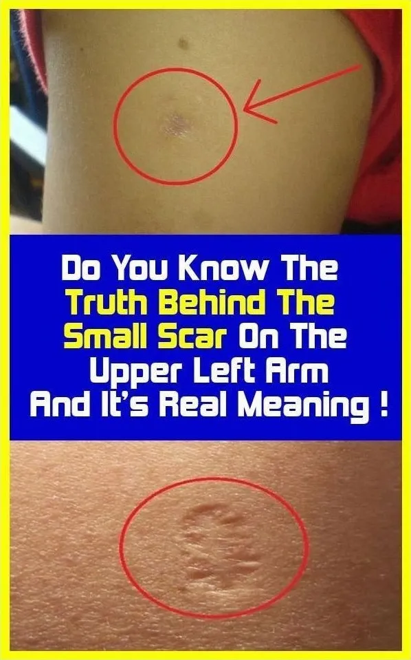 The Truth About the Scar on Your Upper Left Arm