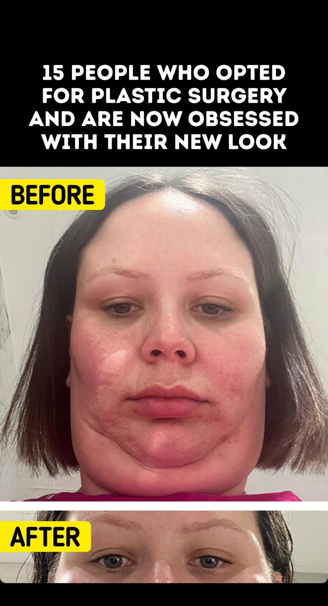 15 People Who Opted for Plastic Surgery and Are Now Obsessed with Their New Look