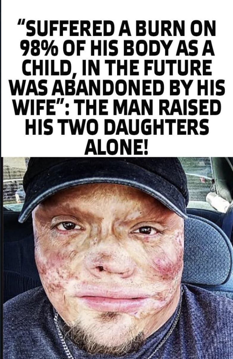 “Suffered a Burn On 98% Of His Body As a Child, In The Future Was Abandoned By His Wife”: The Man Raised His Two Daughters Alone!