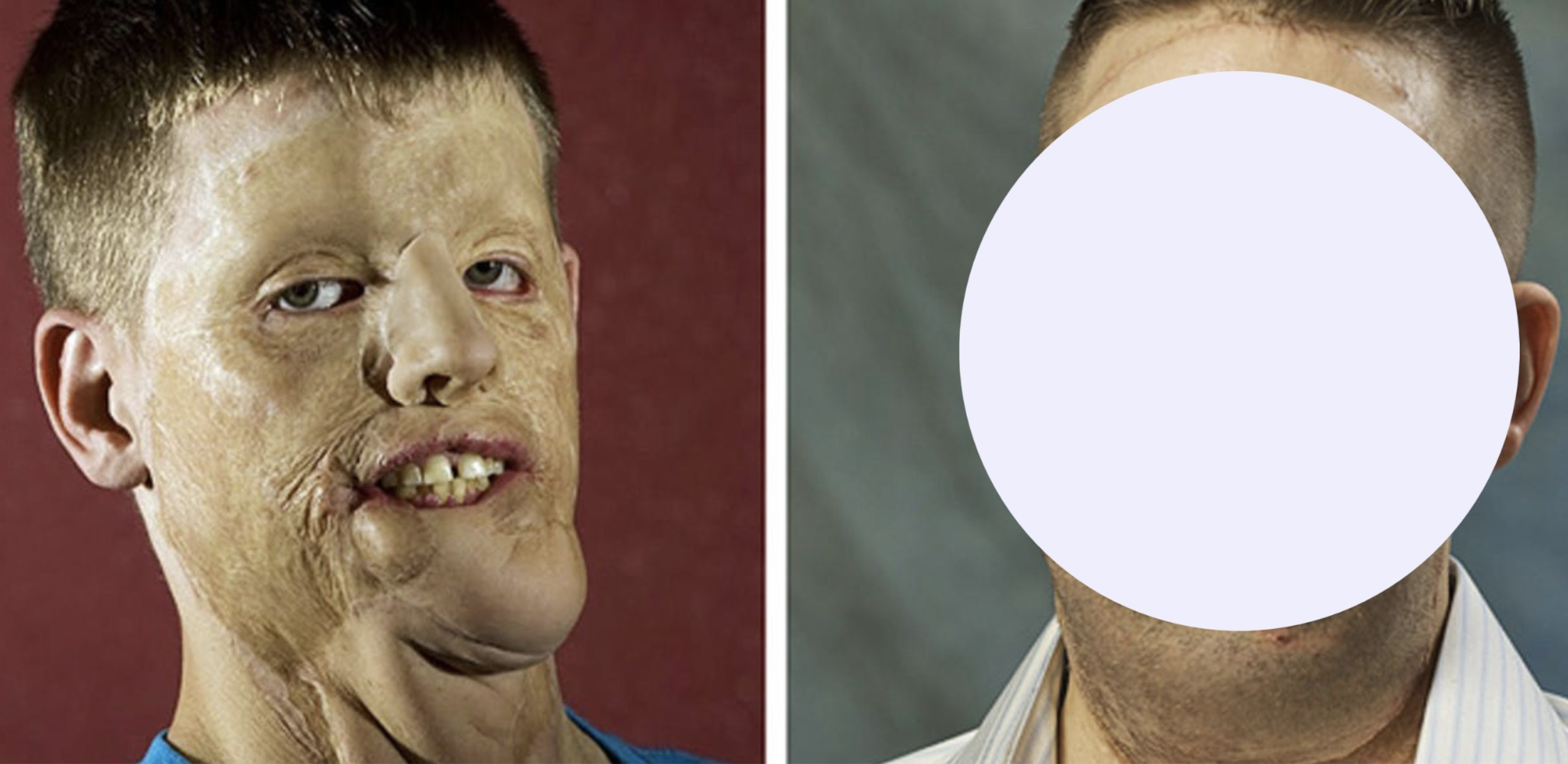 Pictures of Mitch Hunter’s Full Face Transplant ‘Before And After’ An Accident…