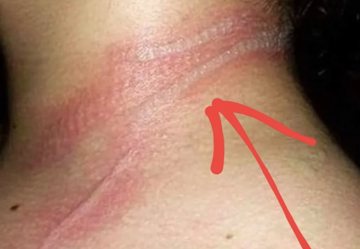 13-year-old girl left with horrific burns on her neck after using her cellphone while it was charging