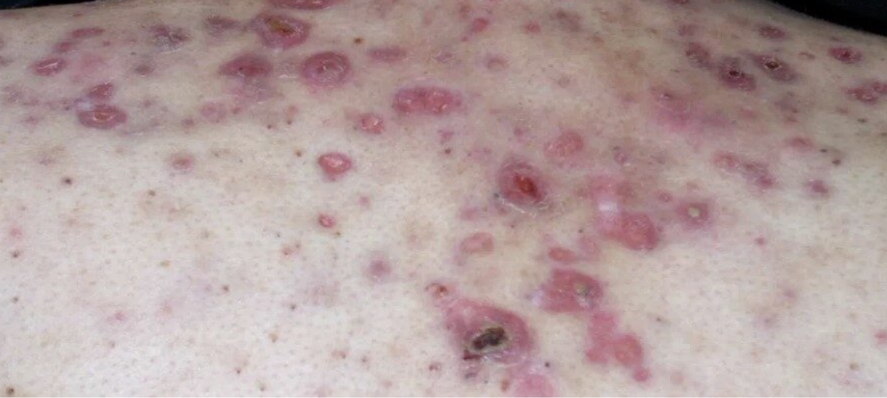 How to identify nodular acne