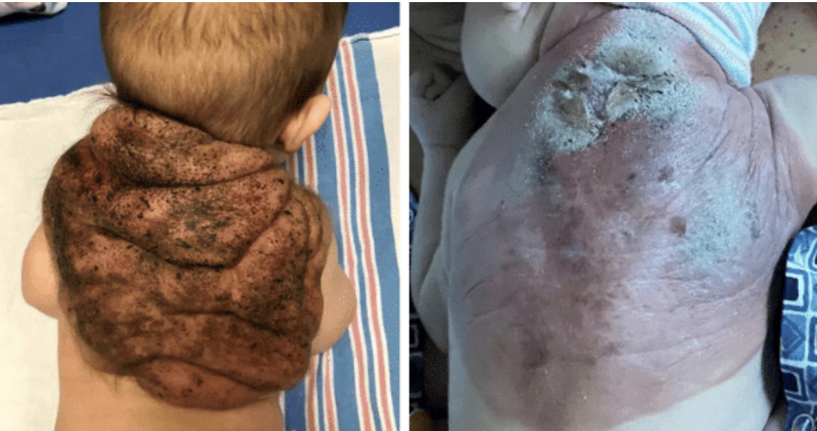 Baby James, the ‘Little Ninja-Turtle’ Born with 75% Back Growth